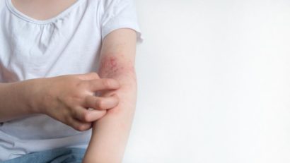 Dermatita atopică, afecţiunea de care suferă aproximativ 10% din români